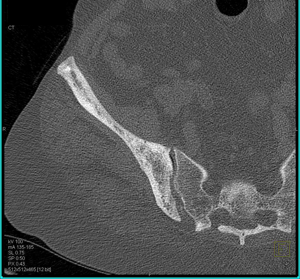 Sclerotic Changes Right Iliac Bone - CTisus CT Scan