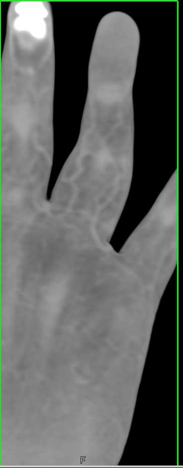Chronic Osteomyelitis with Cellulitis - CTisus CT Scan