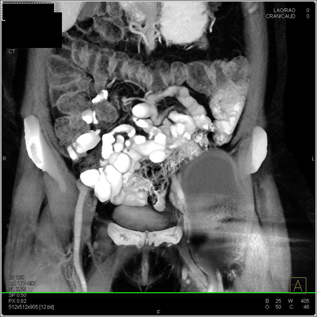 Degenerative Joint Disease (DJD) Left Hip with Large Cyst due to DJD (Large Geode) - CTisus CT Scan