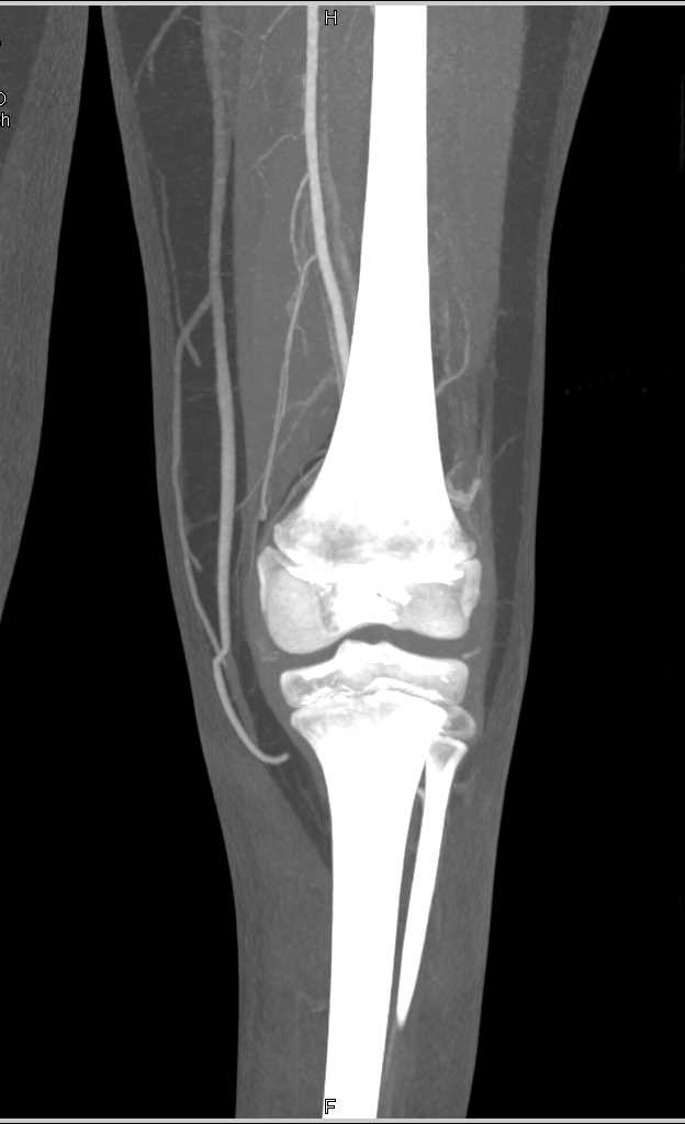 CTA Post Trauma with no Evidence of Vascular Injury - CTisus CT Scan