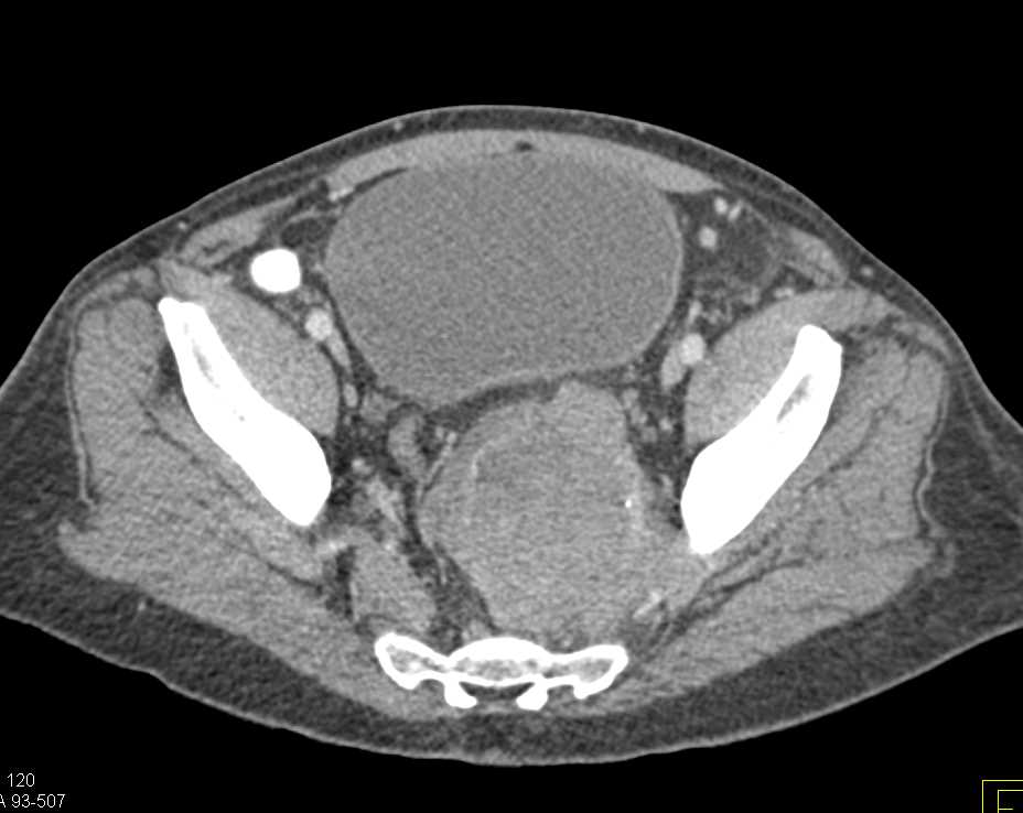 Neurogenic Sarcoma Involves Sacrum - CTisus CT Scan