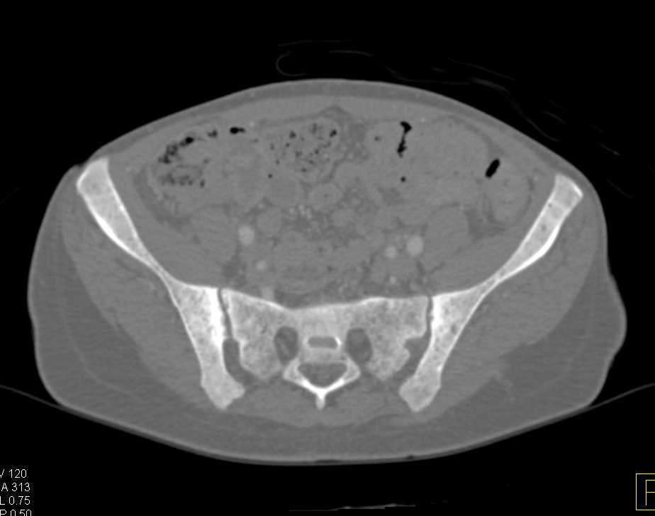 Renal Osteodystrophy with End Stage Renal Disease (ESRD) - CTisus CT Scan