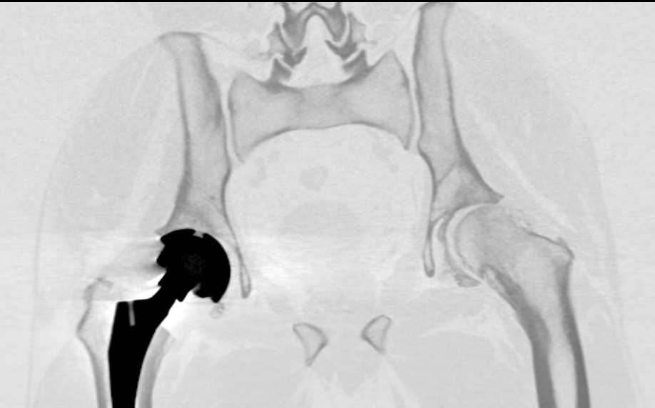 3D of a Right Total Hip Replacement - CTisus CT Scan