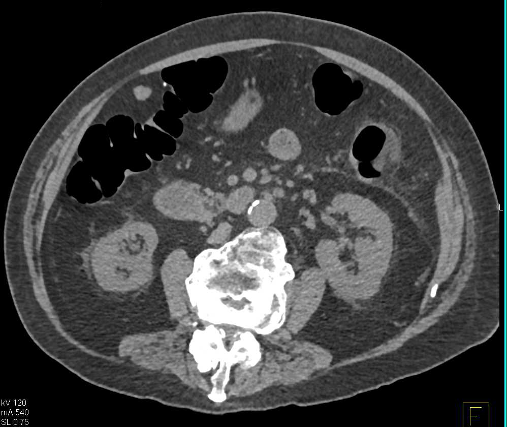 Ankylosing Spondylitis‎ - CTisus CT Scan