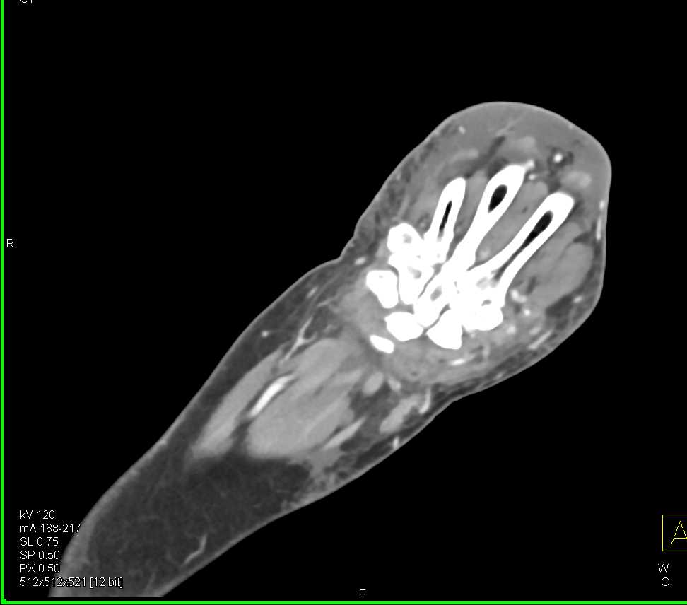 Cellulitis in an Intravenous Drug Abuse (IVDA) Patient - CTisus CT Scan