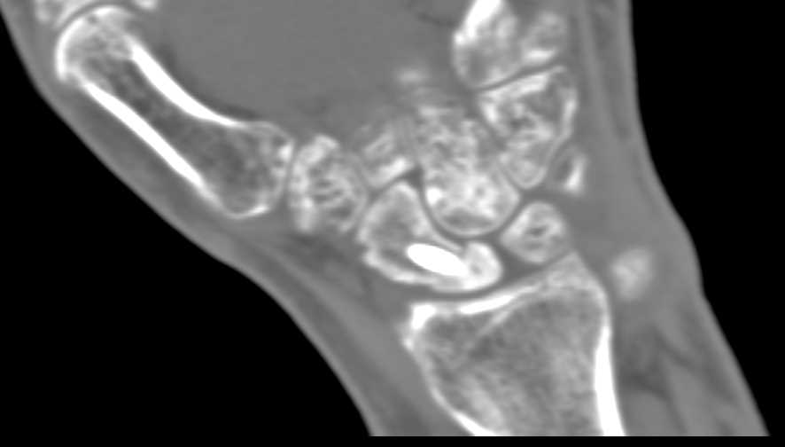 Prior Pinning Scaphoid Fracture - CTisus CT Scan