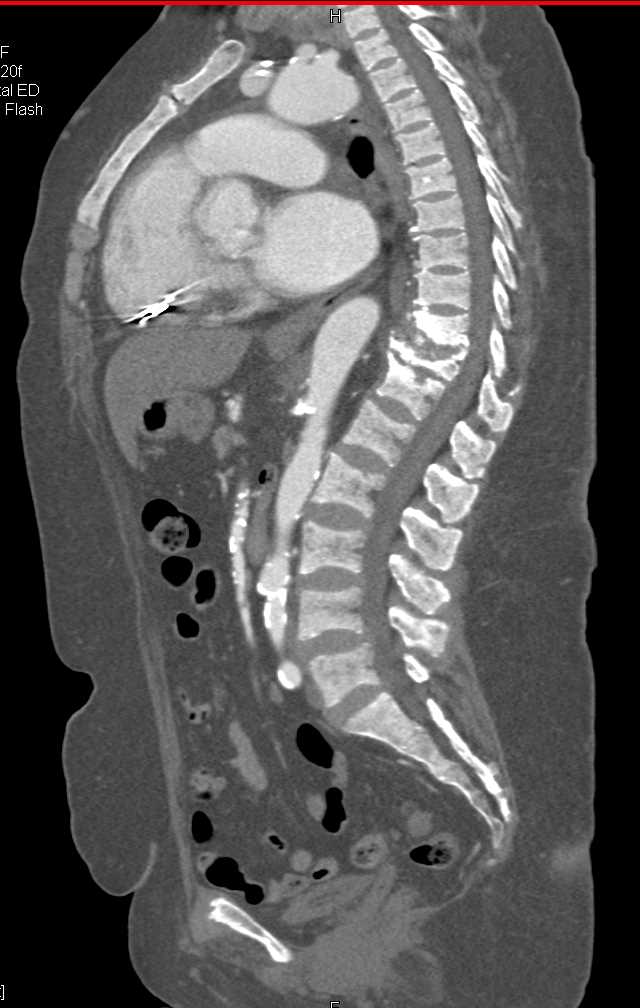 Renal Osteodystrophy with End Stage Renal Disease (ESRD) - CTisus CT Scan