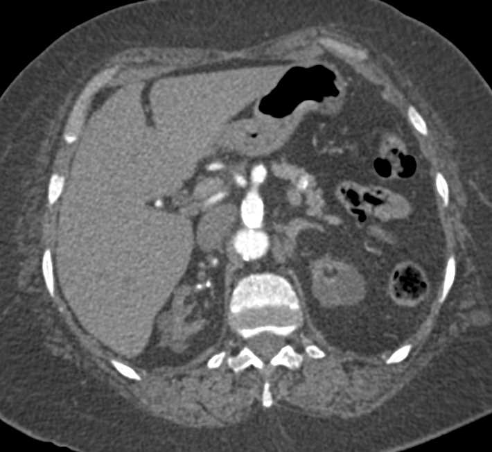 End Stage Renal Disease with Renal Osteodystrophy Especially in Spine - CTisus CT Scan