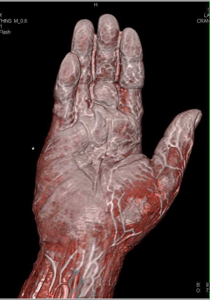 Cellulitis in the Hand with Vascular Mapping - CTisus CT Scan