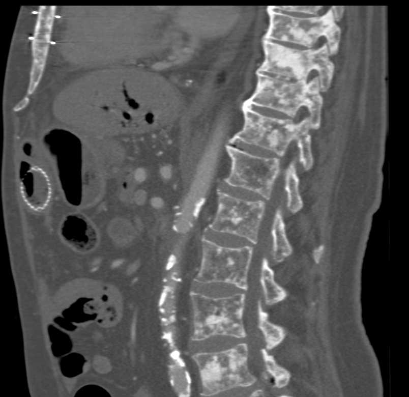 Blastic Bone Metastases from Neuroendocrine Tumor - CTisus CT Scan