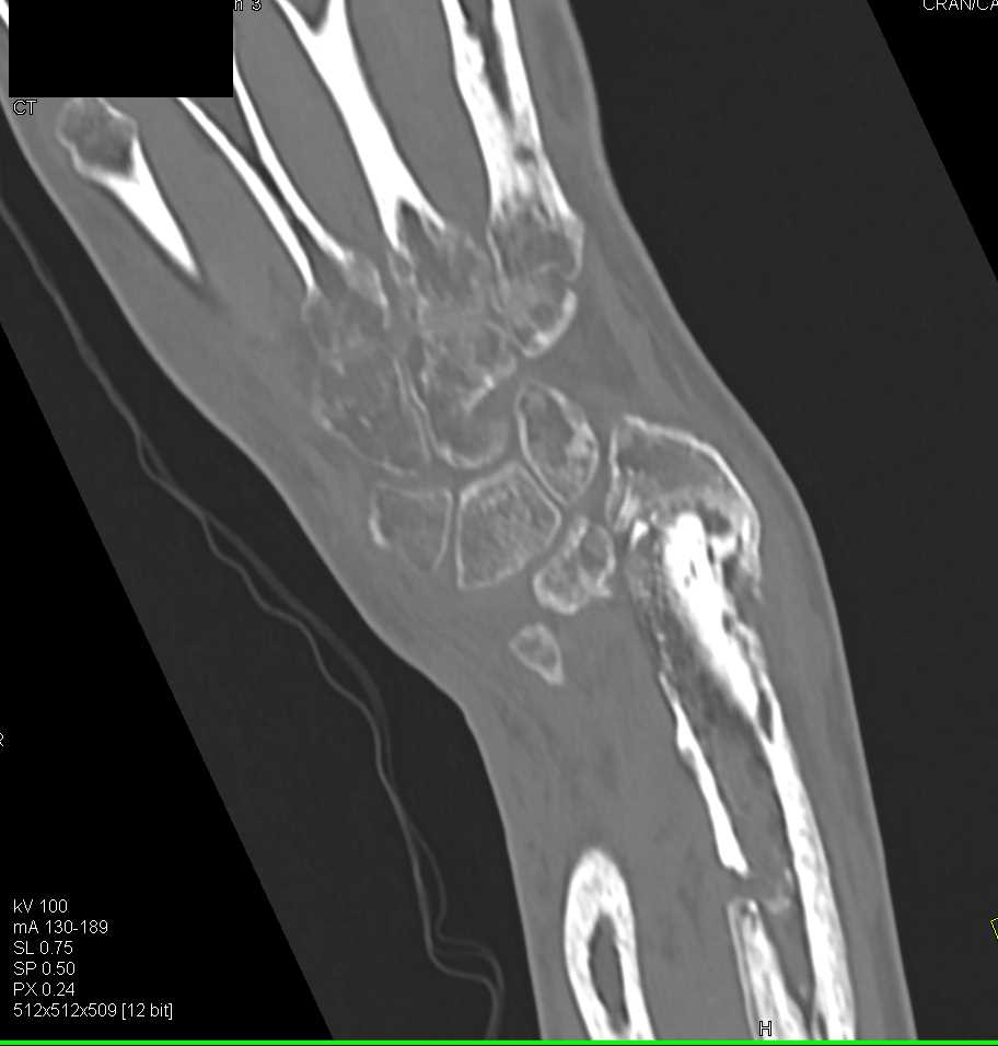 Chronic Osteomyelitis Following Trauma - CTisus CT Scan