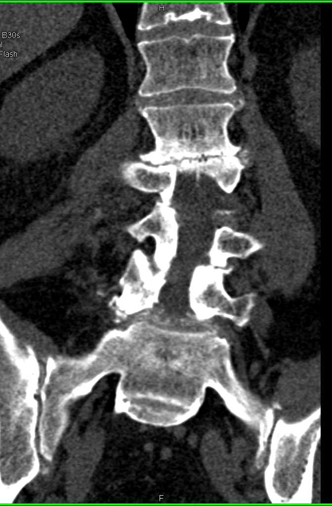 Degenerative Joint Disease (DJD) of Lumbar Spine - CTisus CT Scan