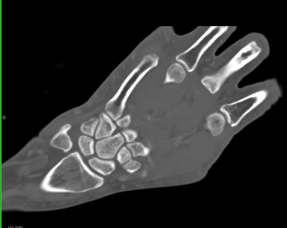Vascular Map of the Wrist and Hand in 3D - CTisus CT Scan