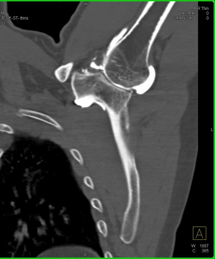 CT Arthrogram in 3D - CTisus CT Scan