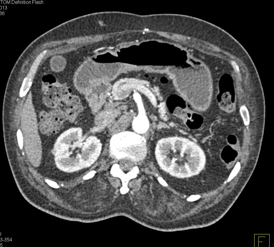 Diffuse Muscle Atrophy - CTisus CT Scan