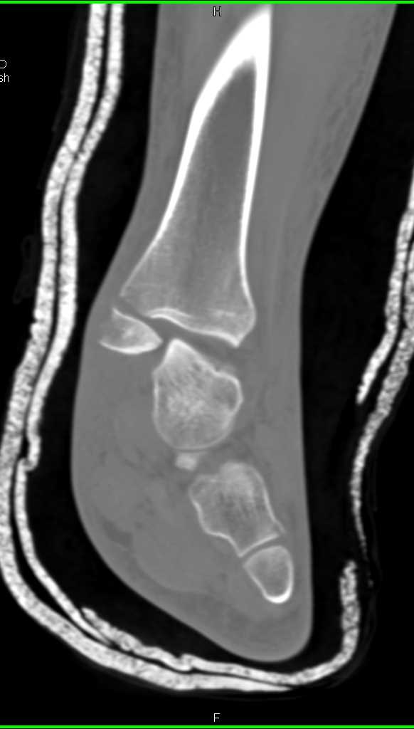 Fracture of Distal Tibia and Fibula with Widening of Ankle Mortise - CTisus CT Scan