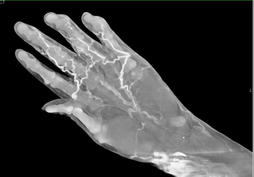 Prior Trauma with Vascular Map and Hardware in Place - CTisus CT Scan