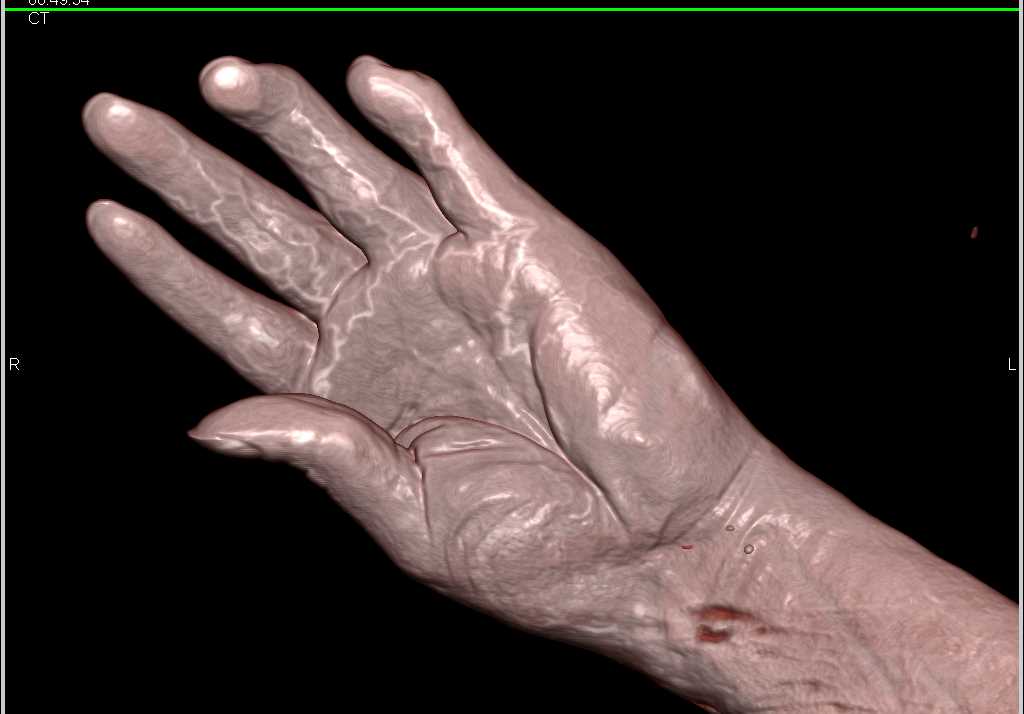 Distal Radius Fracture Repair and 3D Soft Tissue Imaging - CTisus CT Scan