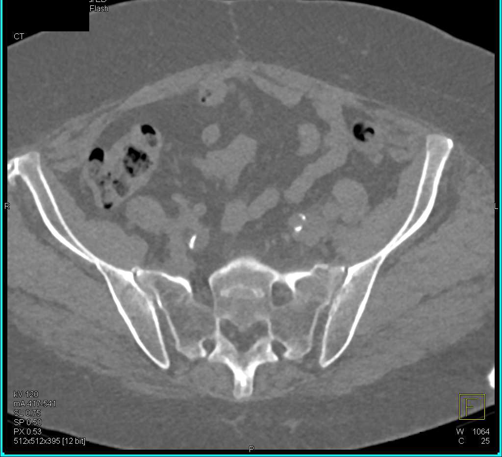 Pelvic Hematoma s/p Trauma Without Pelvic Fractures - CTisus CT Scan