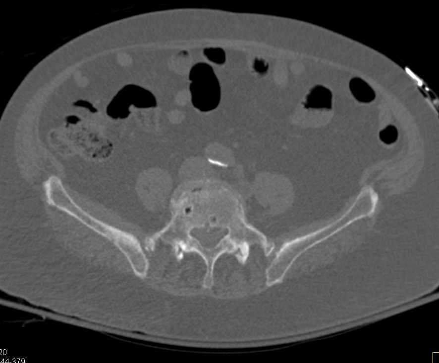 Blastic Metastases to the Right Hemipelvis with Fracture - CTisus CT Scan