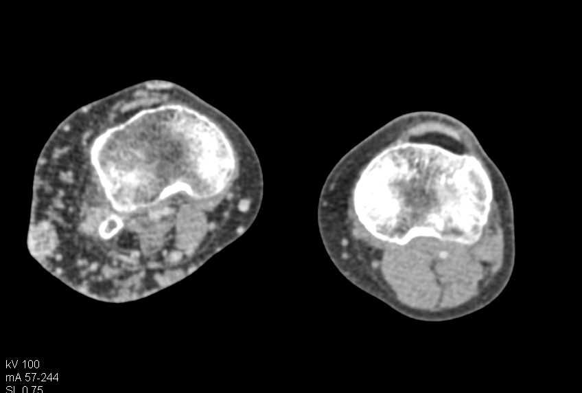 Diffuse Muscle Atrophy Right Lower Extremity with Lymphatic Engorgement - CTisus CT Scan