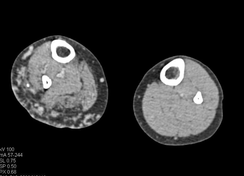 Diffuse Muscle Atrophy Right Lower Extremity with Lymphatic Engorgement - CTisus CT Scan