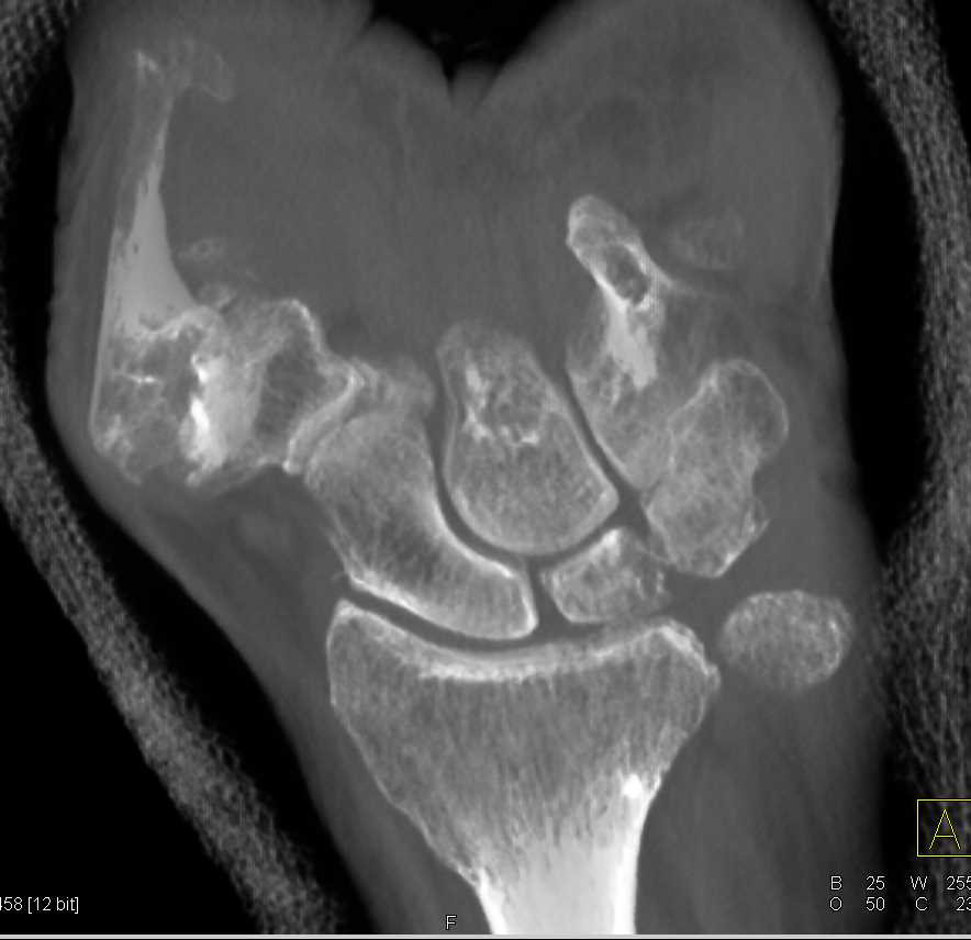 Degenerative Changes in the Carpal Bones - CTisus CT Scan