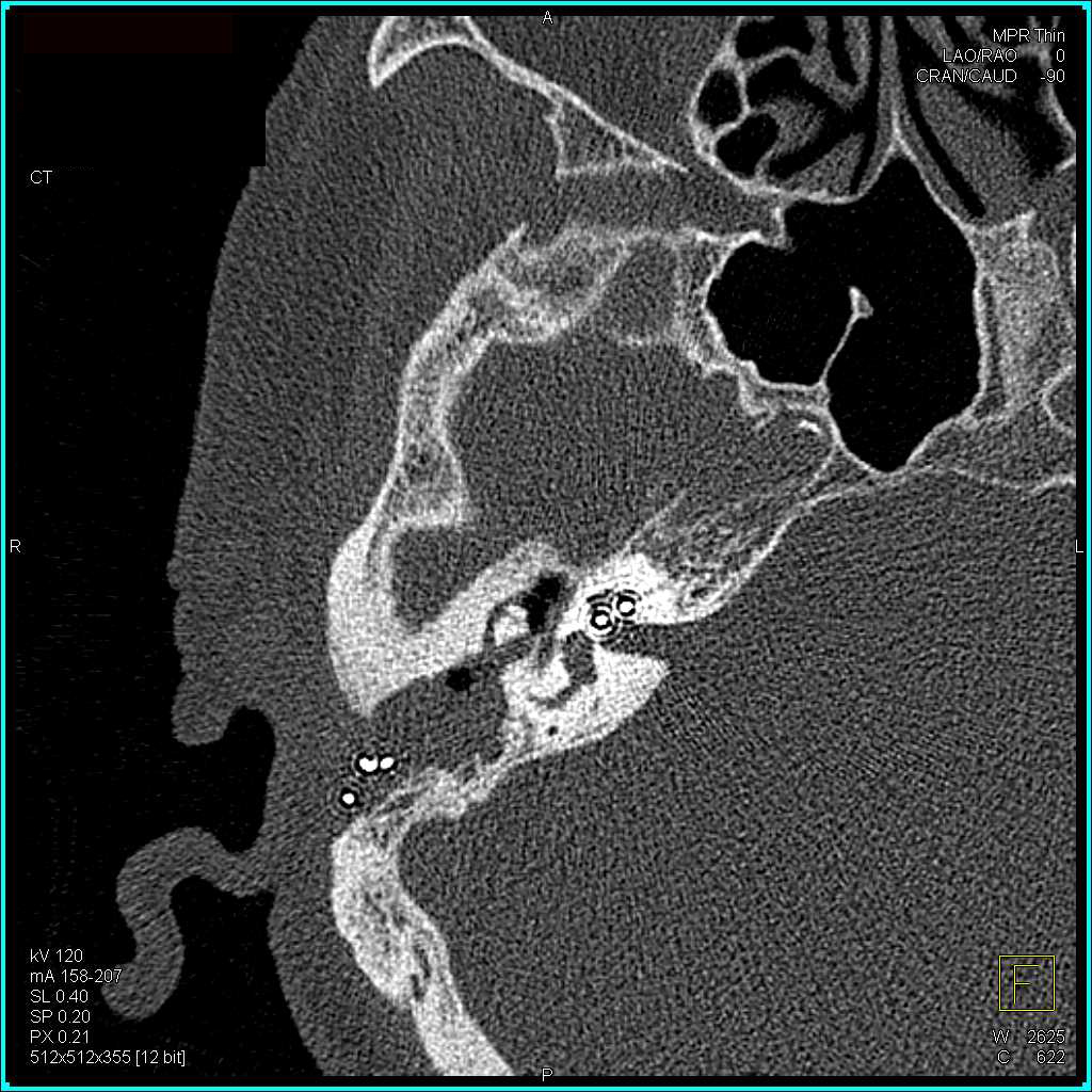 High Resolution Imaging of the Temporal Bone - CTisus CT Scan