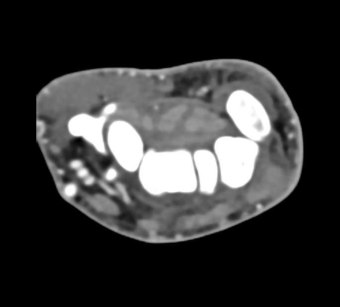 Abscess with Cellulitis in the Forearm - CTisus CT Scan