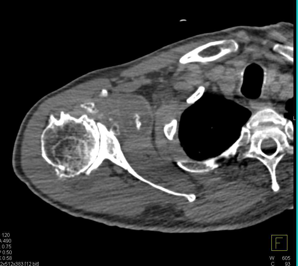 Degenerative Joint Disease (DJD) Shoulder with Large Joint Effusion - CTisus CT Scan