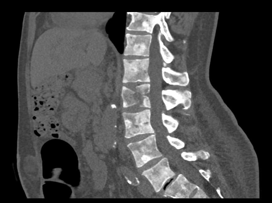 Blastic Metastases to Spine from Bladder Cancer - CTisus CT Scan