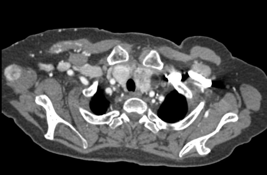 Vascular Metastases to Muscle from Renal Cell Carcinoma - CTisus CT Scan