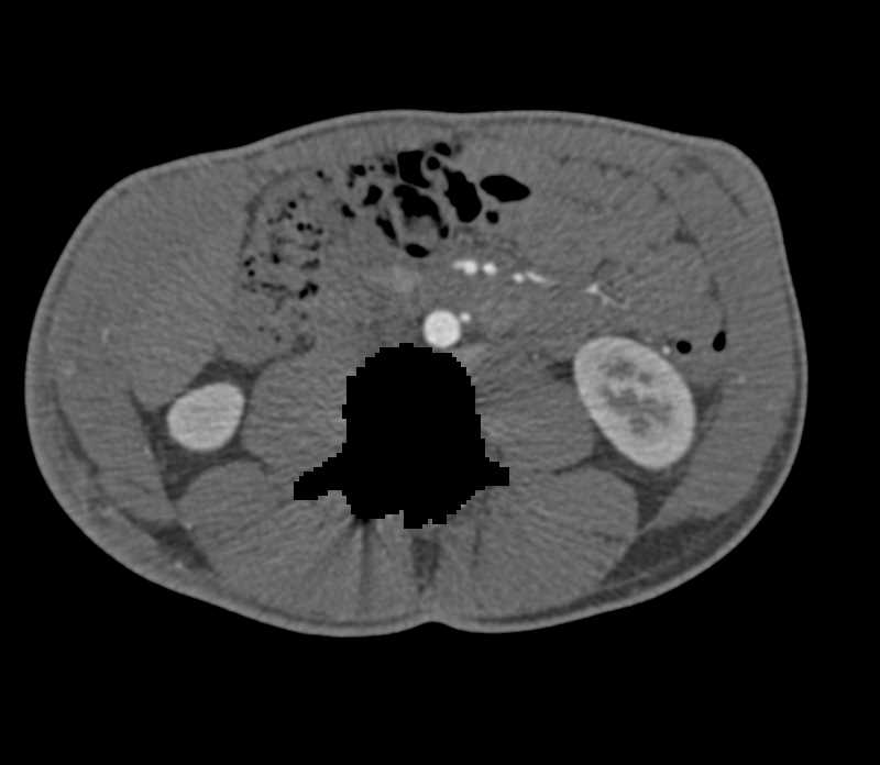 Dual Energy CTA with Prior Fractures Distal Left Tibia and Fibula - CTisus CT Scan