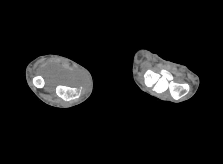 Neurofibromatosis - CTisus CT Scan