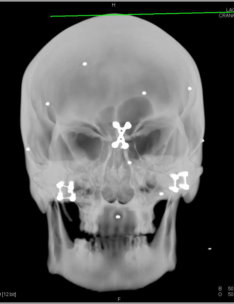 Skull Used to Rehearse Facial Transplant in 3D - CTisus CT Scan