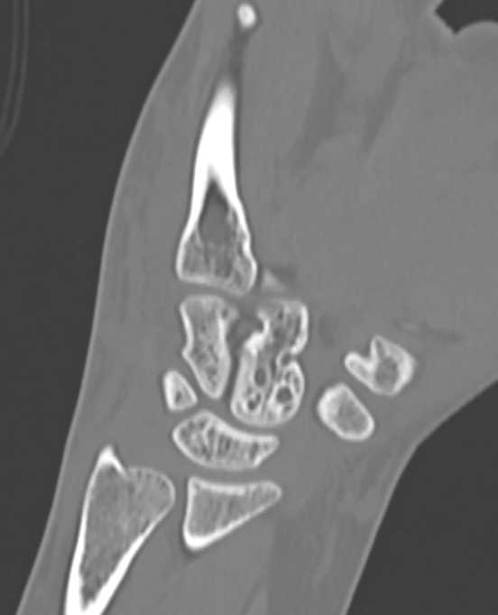Base of 3rd Metacarpal Fracture - CTisus CT Scan