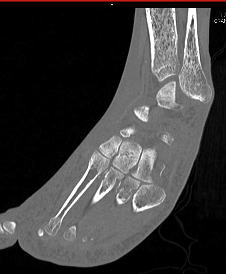 Complex Fracture with Dislocation of the Ankle Joint - CTisus CT Scan