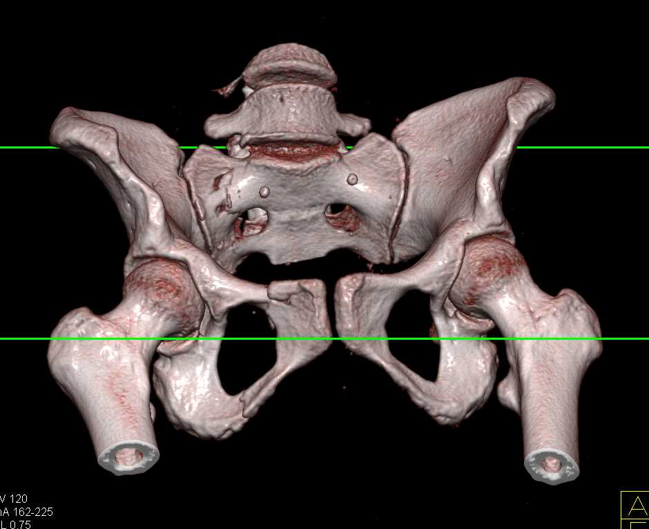 Sacral and Acetabular Fractures with Bladder Trauma and Pelvic Bleed - CTisus CT Scan