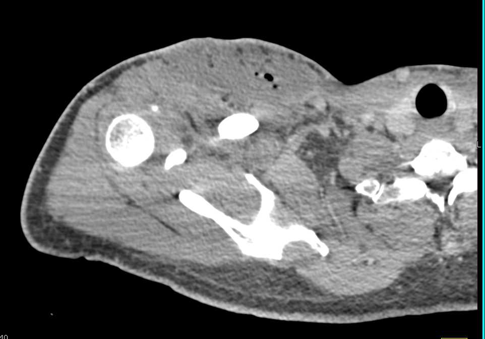Abscess Shoulder with Muscle Necrosis - CTisus CT Scan