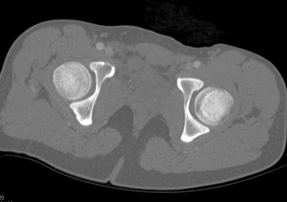 Fracture of the Right Superior and Inferior Pubic Ramus with Negative Angiogram - CTisus CT Scan