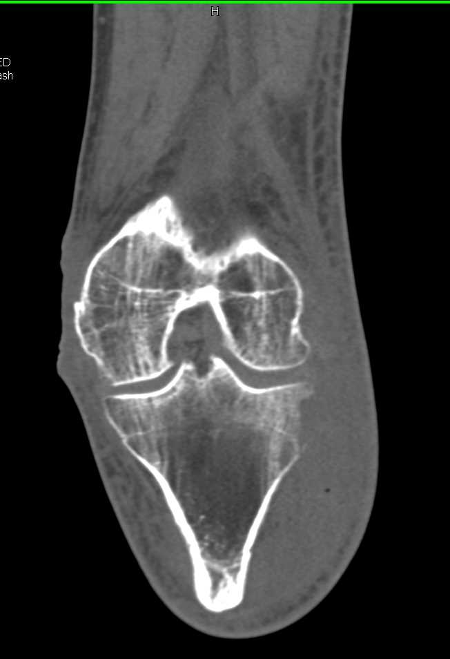 Osteomyelitis Tibia with Bone Erosion - CTisus CT Scan