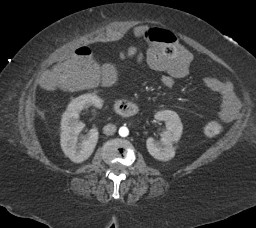 Rectus Hematoma with Active Bleed - CTisus CT Scan