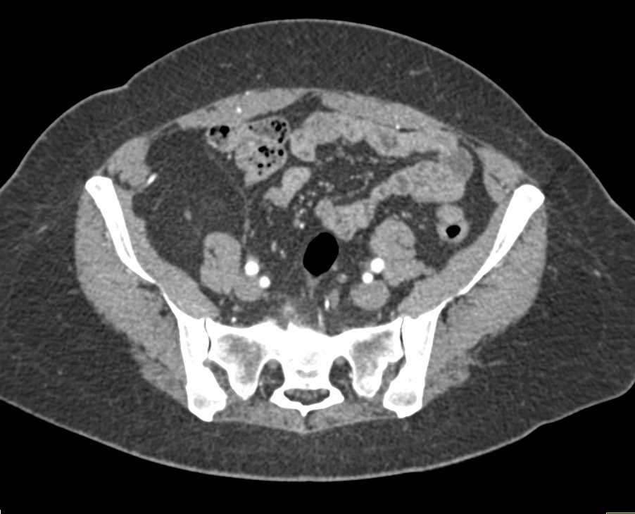 Lipoma Extends into Right Inguinal Ring - CTisus CT Scan