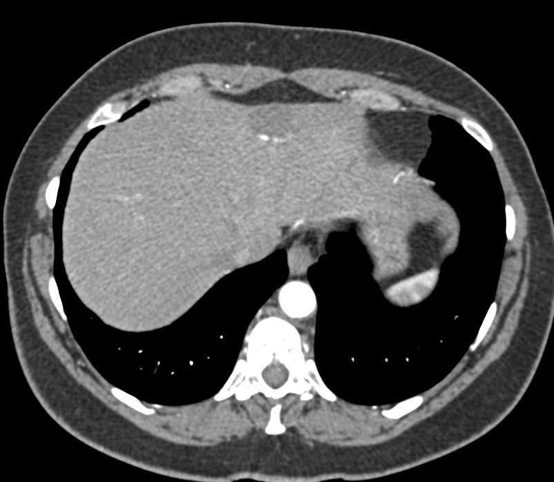 Lipoma Extends into Right Inguinal Ring - CTisus CT Scan
