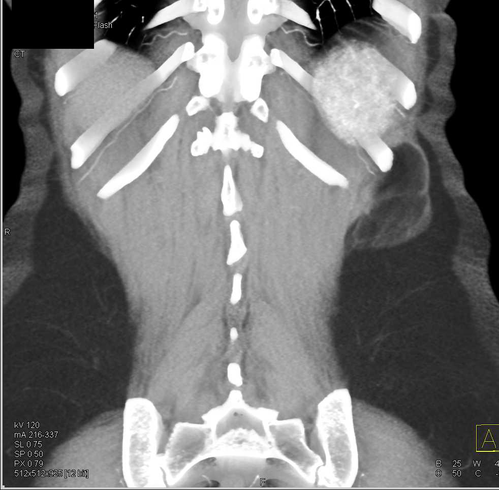 Liposarcoma in Left Paraspinal Area - CTisus CT Scan
