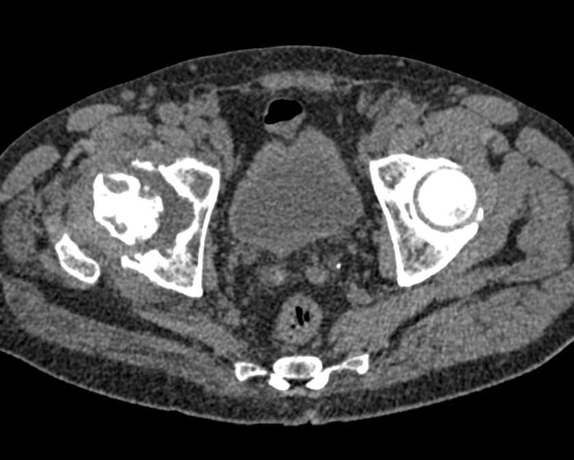 Deformity Right Femoral Head and Acetabulum with Inflamed Joint Space - CTisus CT Scan