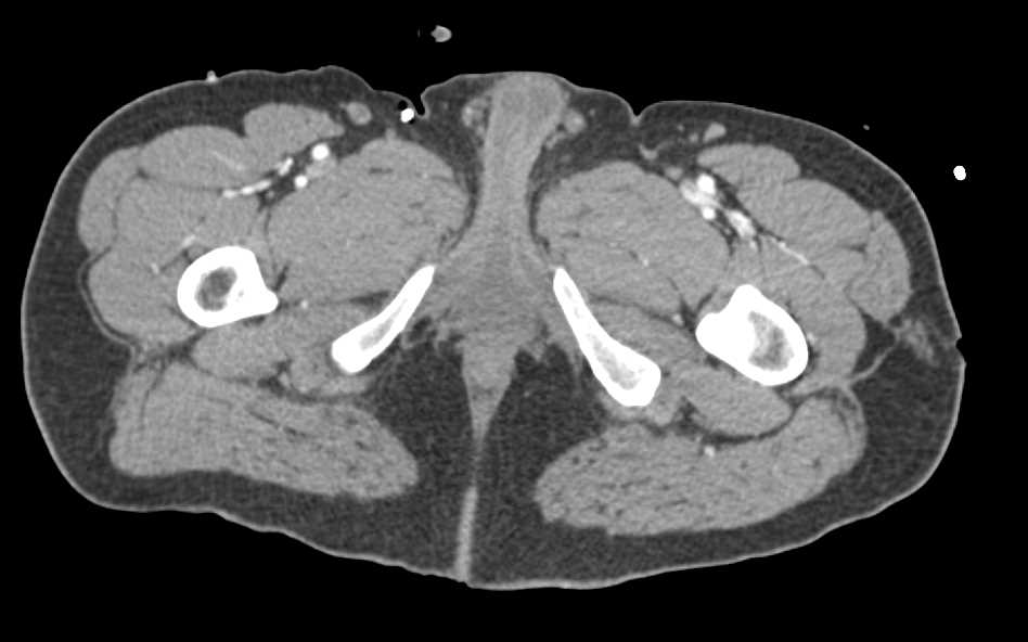 Left Leg Injury with 3D Mapping - CTisus CT Scan