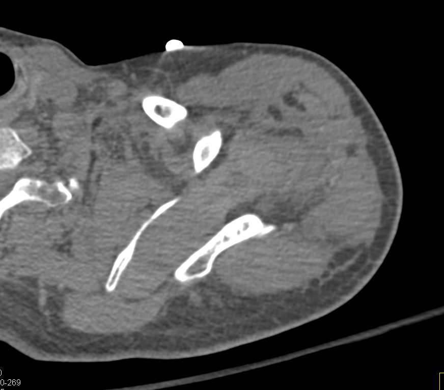 Fracture Dislocation Left Shoulder with Humerus Fracture and Glenoid Fracture - CTisus CT Scan