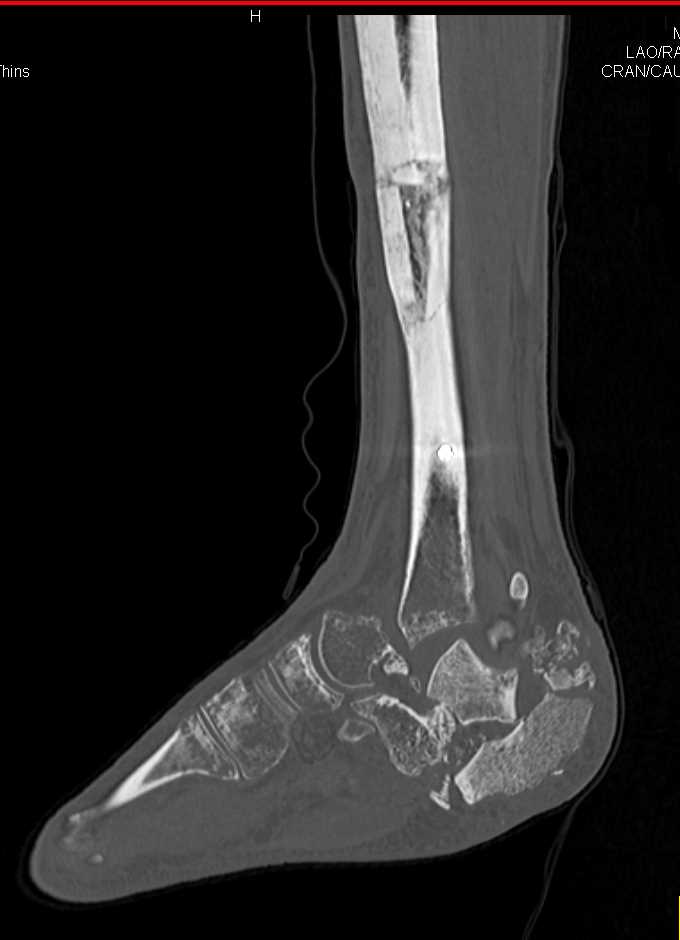 Complex Ankle Fragments in a Neuropathic Joint - CTisus CT Scan