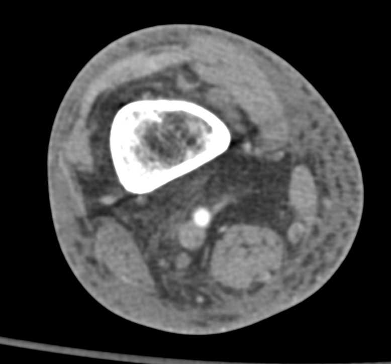 Infection in Muscle and Soft Tissue Following Puncture Wound - CTisus CT Scan
